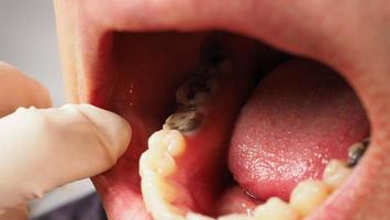 Tratamiento de conductos radiculares de dientes cariados. Diente o caries dental del molar inferior. foto