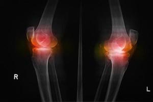 Osteoarthritis both knee . film x-ray AP anterior - posterior of knee show narrow joint space osteophyte spur subcondral sclerosis photo