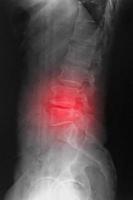 radiografía computarizada cr de la columna lumbosarcal lateral que muestra espondilosis y escoliosis de la columna. foto