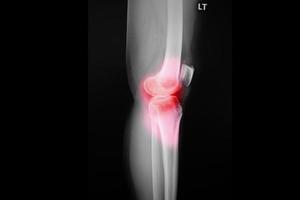 Radiografía de película de rodilla de paciente de rodilla con osteoartritis y articulación artificial foto