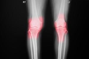 película de rayos X tanto de la rodilla del paciente con osteoartritis de la rodilla como de la articulación artificial foto