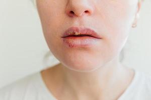 Close up of girl lips affected by herpes. Treatment of herpes infection and virus. Part of young woman face, lips with herpes affected. Beauty dermatology concept. photo