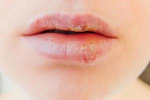 Close up of girl lips affected by herpes. Treatment of herpes infection and virus. Part of young woman face, lips with herpes affected. Beauty dermatology concept.