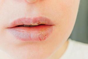 Close up of girl lips affected by herpes. Treatment of herpes infection and virus. Part of young woman face, lips with herpes affected. Beauty dermatology concept. photo