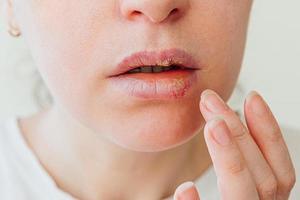Close up of girl lips affected by herpes. Treatment of herpes infection and virus. Part of young woman face with finger touching pain on lips with herpes affected. Beauty dermatology concept.