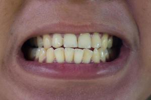 a man's teeth are yellow photo