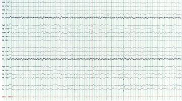 Photography of sharp wave during interictal EEG in epilepsy photo