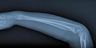 Broken arm xray photo