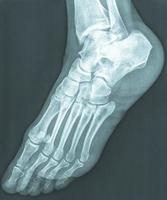 female feet xray radiograph photo