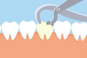 dentista sacando un diente muerto con equipo. actividades de cuidado dental con una pinza de dentista y un vector de diente muerto. ilustración de extracción de dientes muertos. concepto de extracción de dientes.