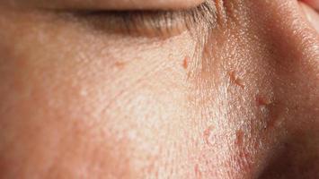 Wart skin removal. Macro shot of warts near eye on face. photo