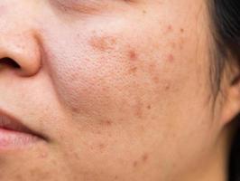 Problems facial skin is acne and blemishes. photo