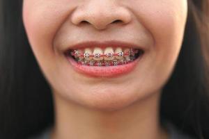 smiling asian woman I orthodontic. Detail of young womans smile showing white teeth with braces. photo