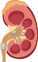 kidney stones flat vector illustration
