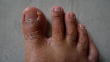 photo of man's feet and toes