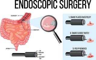 diagrama que muestra la cirugía endoscópica vector