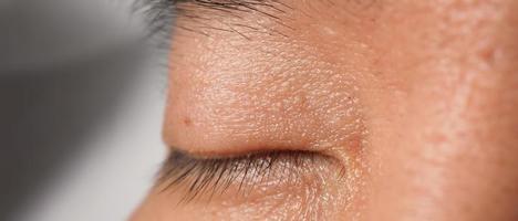 Wart skin removal. Macro shot of warts near eye on face. photo