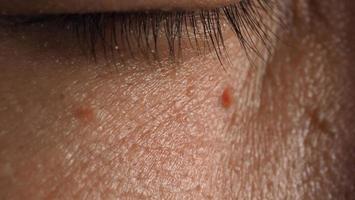 Wart skin removal. Macro shot of warts near eye on face. photo