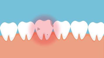 dent morte blessant et donnant un signal de douleur rouge animation 4k. dent infectée par des caries et des images 4k de la mâchoire douloureuse. une dent morte pourrie avec un signal de danger rouge et une animation. video