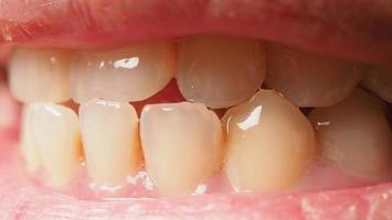 Tratamiento de conductos radiculares de dientes cariados. Diente o caries dental del molar inferior. foto