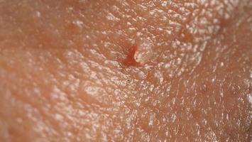 Wart skin removal. Macro shot of warts near eye on face. photo