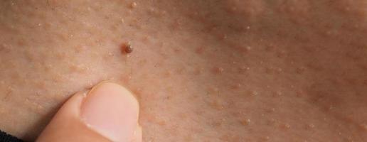 Wart skin removal. Macro shot of warts near eye on face. photo