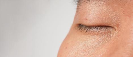 Eliminación de piel de verrugas. toma macro de verrugas cerca del ojo en la cara. foto