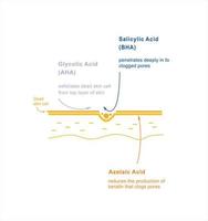 Acid exposure on skin. Skin care exfoliating. Salicylic, glycolic, azelaic acid. Infographics beauty treatment. Vector illustration.