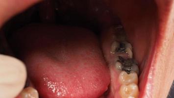 Tratamiento de conductos radiculares de dientes cariados. Diente o caries dental del molar inferior. foto