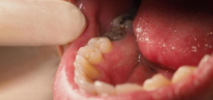 Tratamiento de conductos radiculares de dientes cariados. Diente o caries dental del molar inferior. foto