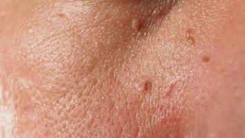 Wart skin removal. Macro shot of warts near eye on face. photo