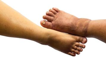 Isolate both of the toes of fat people. photo