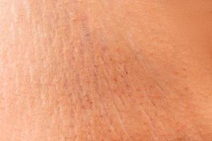 Stretch marks on the skin, wrinkles,obeseness photo