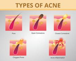 Acne,stages of development,healthy skin,vector design vector