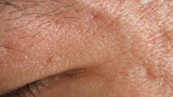 Wart skin removal. Macro shot of warts near eye on face. photo