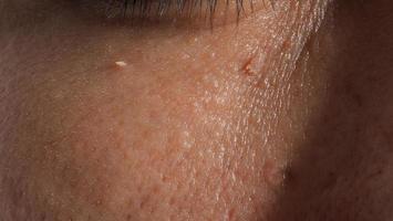 Wart skin removal. Macro shot of warts near eye on face. photo