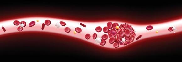 Ilustración 3d de un coágulo de sangre en un vaso sanguíneo que muestra un flujo sanguíneo bloqueado con plaquetas y glóbulos blancos en la imagen.