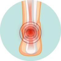 Achilles tendo rupture in circle template vector