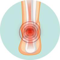 Achilles tendo rupture in circle template vector