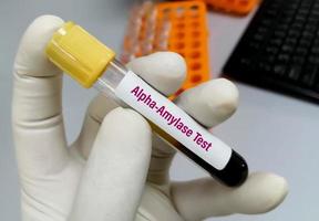 Biochemist or Lab Technologist holds Blood sample for Alpha Amylase enzyme test. Diagnosis of pancreatitis in the laboratory background. photo