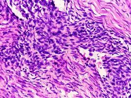 un portaobjetos histológico de una muestra de tejido. vista microscópica cercana. histopatología carcinoma. adenocarcinoma foto