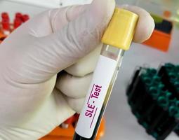 Blood sample for Systemic lupus erythematosus or SLE test. autoimmune disease photo