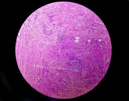 un portaobjetos histológico de una muestra de tejido. vista microscópica cercana. histopatología foto