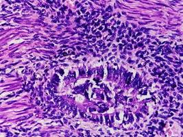 A histological slide of a tissue sample. Close microscopic view. Histopathology. carcinoma. adenocarcinoma photo