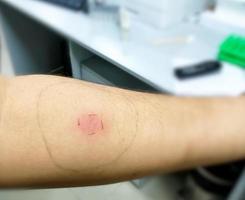 Mantoux vaccination, Closeup view photography of patient arm with red spot reaction to conducting Mantoux test. Positive tuberculocis patient.