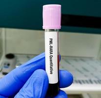 PML-RARA quantitative test in PCR laboratory. it provides a general estimate of the number of PML-RARA gene sequences present in a person's blood or bone marrow samples. promyelocytic Leukemia. photo
