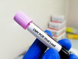 Cytomegalovirus  or CMV PCR viral load for DNA Detection and Quantification photo
