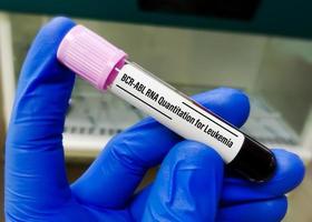 BCR ABL RNA Quantitation test is used to diagnose or rule out chronic myeloid leukemia or a specific form of acute lymphoblastic leukemia photo