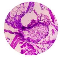 High magnification of skin cells infected with the HPV Virus. Common Wart. Verruca vulgaris. Microscopic view. photo