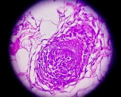 High magnification of skin cells infected with the HPV Virus. Common Wart. Verruca vulgaris. Microscopic view. photo